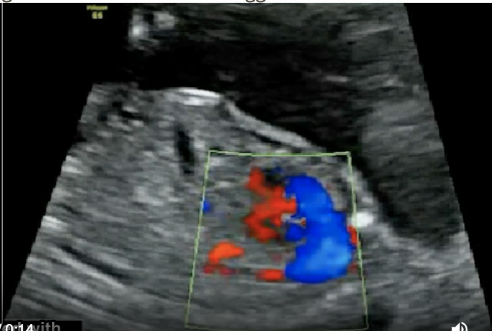 <p>a) congenital cystic adenomatoid malformation</p><p>b) pulmonary sequestration</p><p>c) diaphragmatic hernia</p><p>d) echogenic bowel</p>