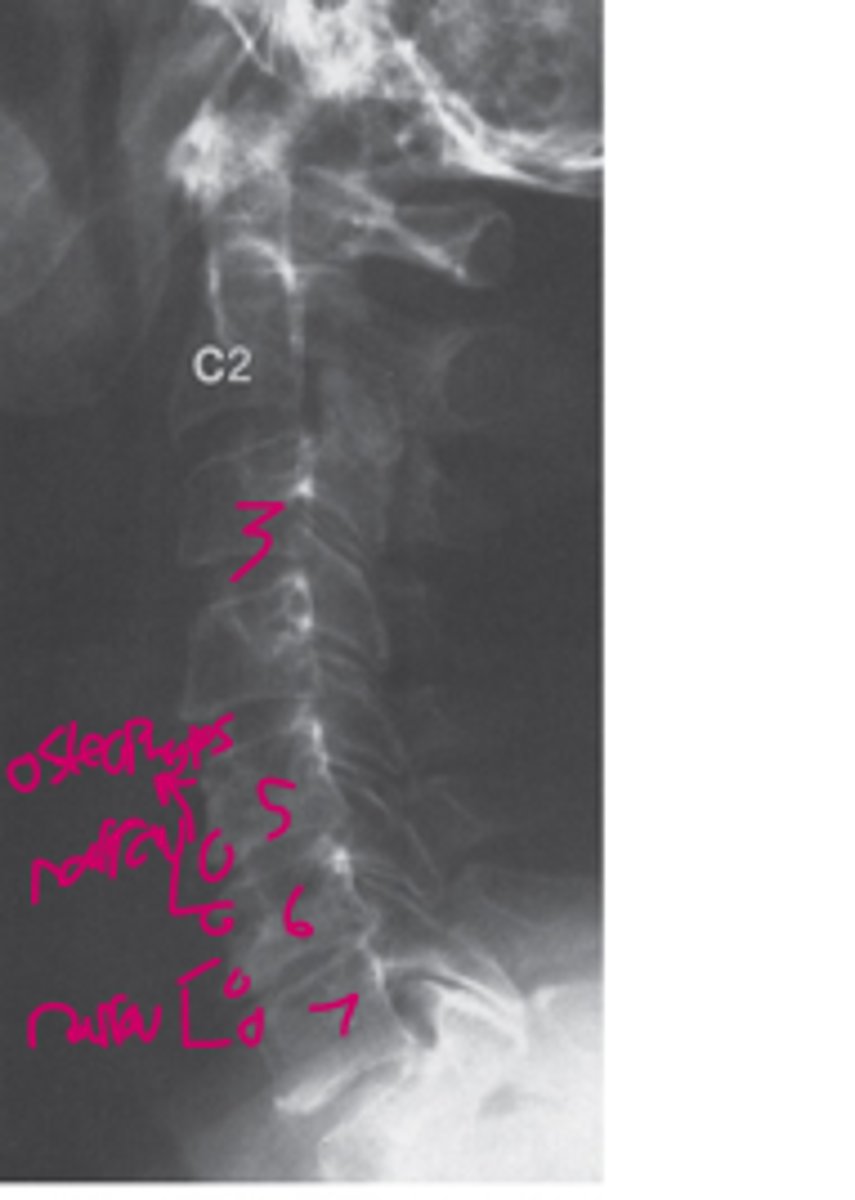 <p>The lateral cervical spine plain film suggests that the most likely diagnosis is</p><p>degenerative disk disease at C2-3 and C3-4.</p><p>neoplastic disease at C4.</p><p>degenerative disk disease at C5-6 and C6-7.</p><p>traumatic injury.</p><p>disk space infection at C5-6 and C6-7.</p>