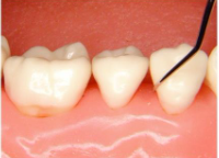 <p><span><strong> The lower shank crosses the facial surface (not parallel)</strong></span></p><p><span><strong> The functional shank is “down and around” the </strong></span><strong>tooth.</strong></p>