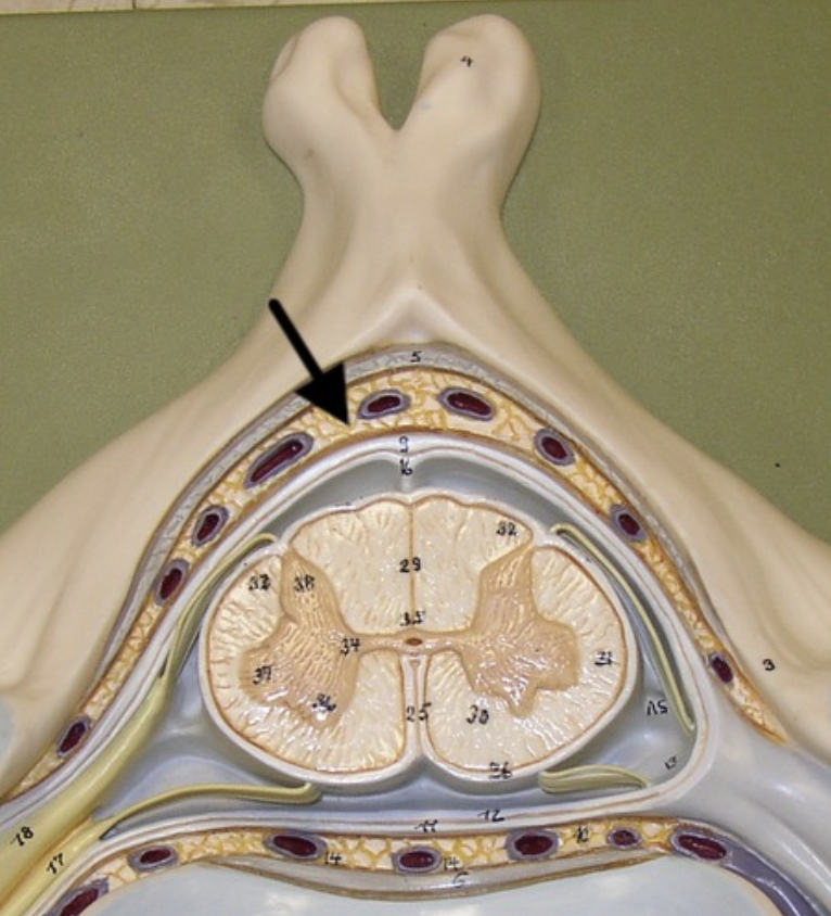 <p>Fat-filled space between the vertebrae and dura mater - largest at T2</p>