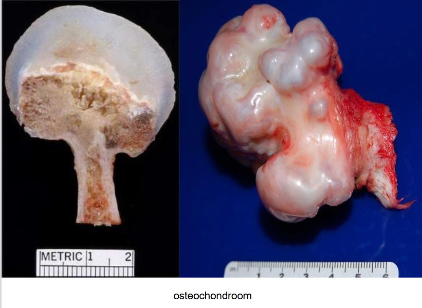 <p>MEDISCHE TOEPASSING: osteochondroma (exostose)</p>