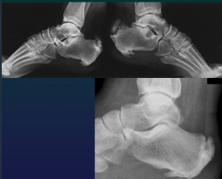 <ul><li><p>Tendon insetion</p></li><li><p>Iliac crest</p></li><li><p>Grater trochanter</p></li><li><p>Ischiatic tubeerosity </p></li><li><p>Calcanean enthesitis </p></li></ul><p></p>