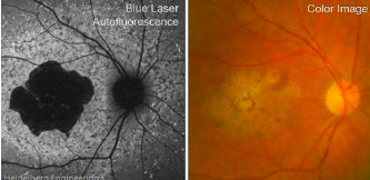 <p>age related macular degeneration</p>