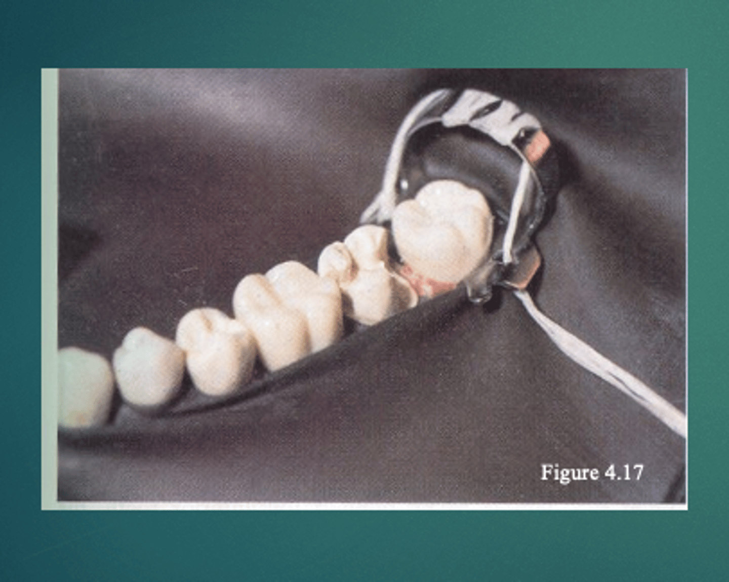 <p>**attach a piece of floss</p><p>- prevents the patient accidentally swallowing the clamp</p><p>- prevents injury to dental team from flying debris caused by an improper seat of the clamp</p>