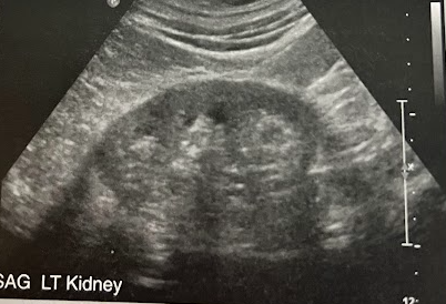 <p>A 65 year old man undergoes a renal sonogram b/c of proteinuria and hematuria. He was diagnosed w/diabetes 12 yrs ago and has has a 15 yr hx of hypertension. He admits not taking his meds like he should and c/o being overly tired. Sonographically, the kidneys have thinned cortex and demonstrate a slight increase in cortical echogenicity. What is the most likely diagnosis?</p>