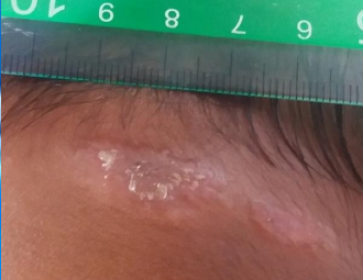 <p>A palpable flat lesion more than 1 cm in diameter</p>