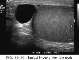 <p>an asymptomatic patient presents with a palpable right scrotal mass discovered during a recent physical exam. The ono finding is most consistent with</p>