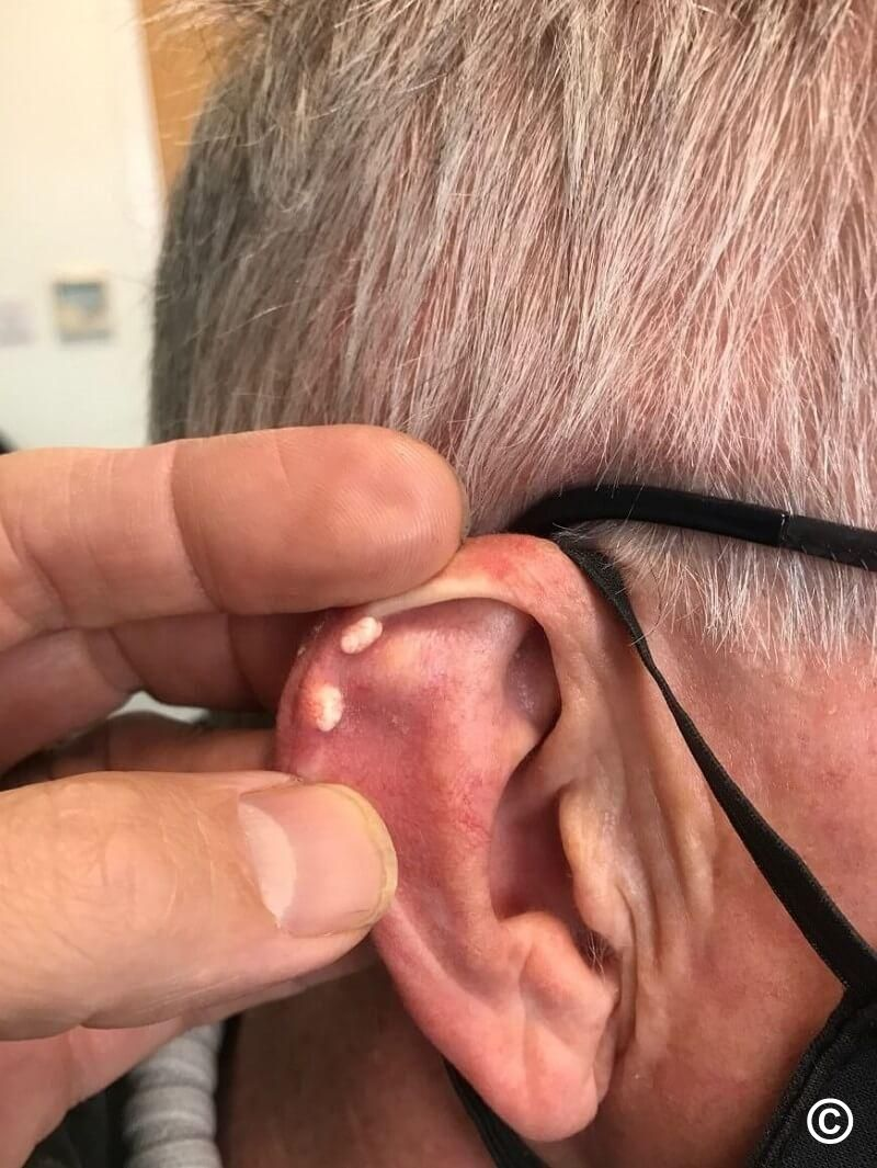 <p>hx of gout</p><p>deposit of uric acid crystals</p><p>characteristic of chronic gout</p><p>hard nodule in the helix/antihelix</p><p>may discharge chalky white crystals through the skin</p>