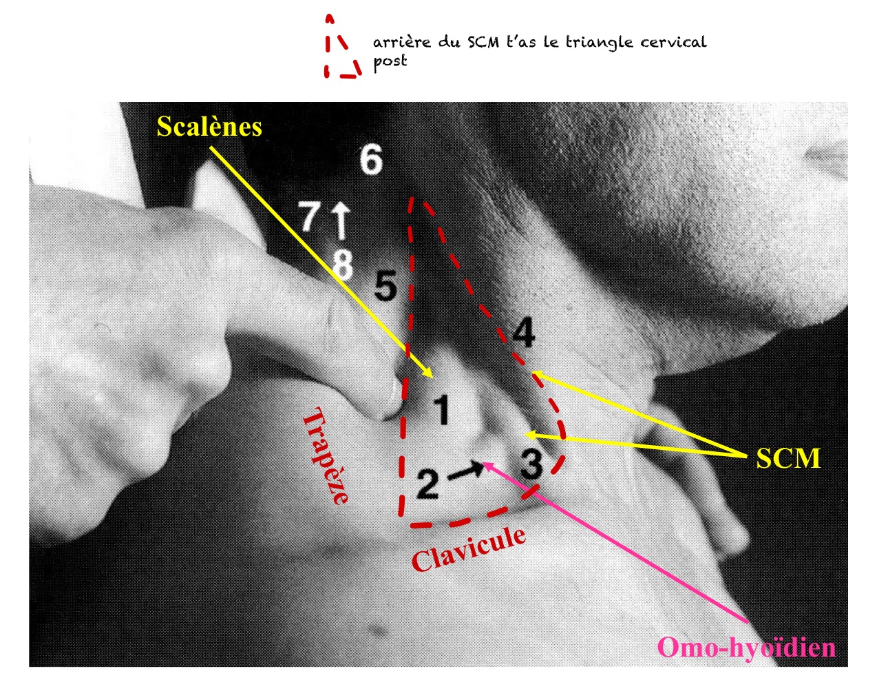 <p>triangle cervical postérieur</p><p>av: bord post SCM</p><p>ar: bord ant trapèze</p><p>en bas: clavicule</p>
