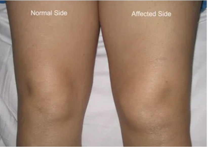 <p><span>What is the affected side showing?</span></p><p></p>