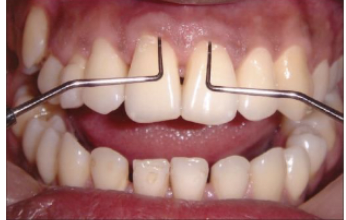 <p>Enamel-covered groove on the root resulting in deep probing, food impaction</p>