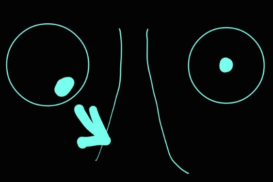 <p>inferior rectus muscle</p>