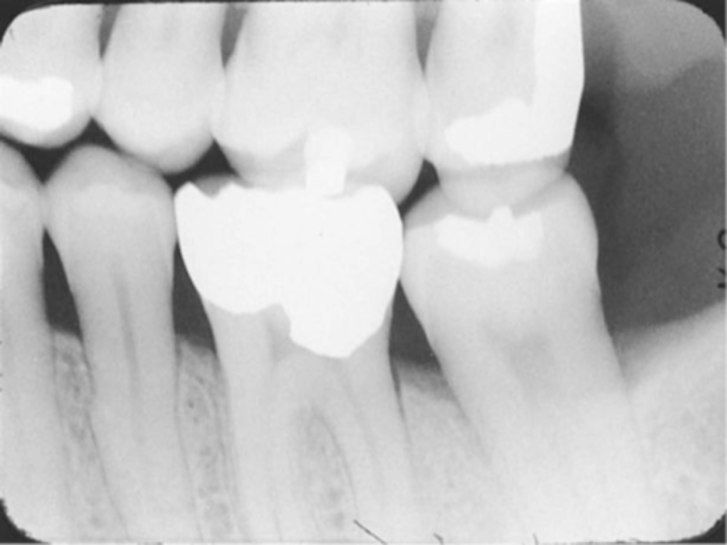 <p>-Images appears distorted</p><p>-Negative angulation was used</p><p>-To avoid always use a +10 degree vertical angulation with the bite-wing technique to compensate for the slight tilt of max teeth and slight lingual bend of the upper half of the receptor caused by the hard palate.</p>