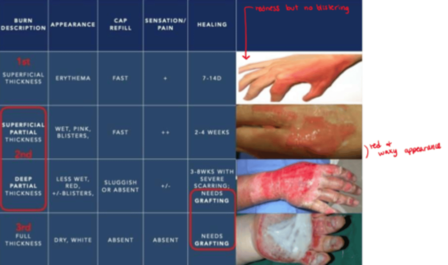 <p>- involves full dermis (&amp; epidermis) + subcutaneous tissue</p><p>- no blisters; waxy to black; eschar formation ("charred surface")</p><p>- no pain, no tactile sensation, loss of function &amp; no cap refill (needs grafting)</p><p>- no regeneration => dead tissue (eschar) needs to be debrided most likely (make sure they can maintain ABCs still post debridement!)</p>