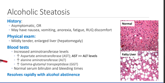 <ol><li><p>↑ Aspartate aminotransferase (AST); AST >> ALT levels</p></li><li><p> ↑ alanine aminotransferase (ALT)</p></li><li><p> ↑ Gamma-glutamyl transpeptidase (GGT)</p></li></ol><p></p>