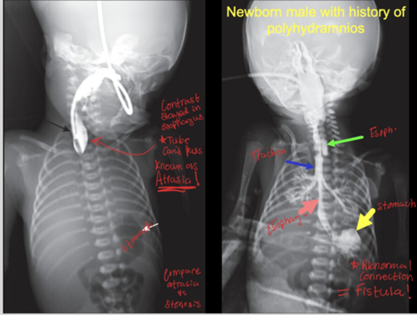 <p>The fetus cannot swallow amniotic fluid.</p>