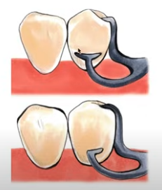 <ul><li><p>T bar </p></li><li><p>Modified T bar</p></li></ul><p></p>