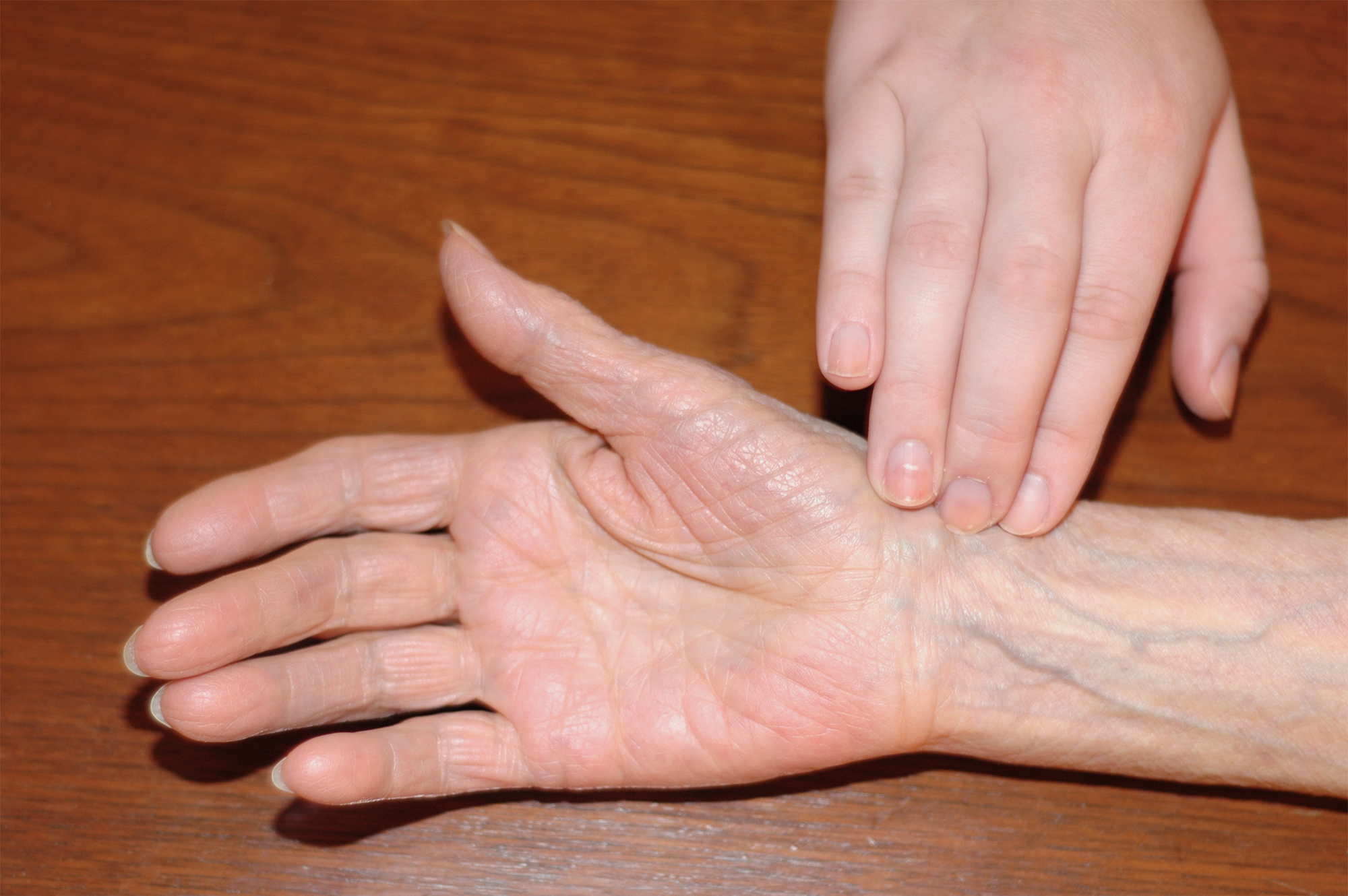 <ul><li><p>thumb side of wrist</p></li><li><p>“radical thumb”</p></li></ul><p></p>