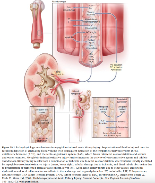 <ul><li><p><span>Renal vasoconstriction</span></p></li><li><p><span>Direct and ischemic tubule injury</span></p></li><li><p><span>Tubule obstruction by myoglobin cast formation</span></p></li></ul><p></p>