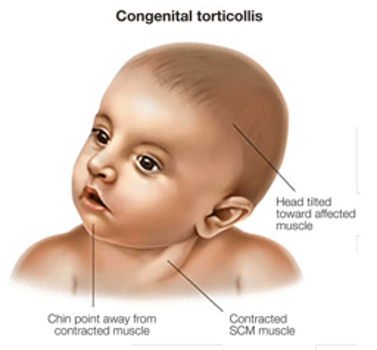 <p>abnormal contraction of SCM (head tilted to side of involvement)</p>