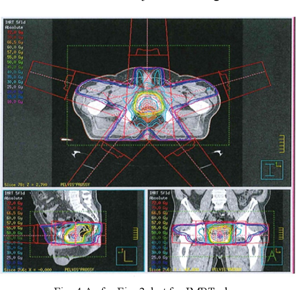 <p>there are parallel opposed beams </p>