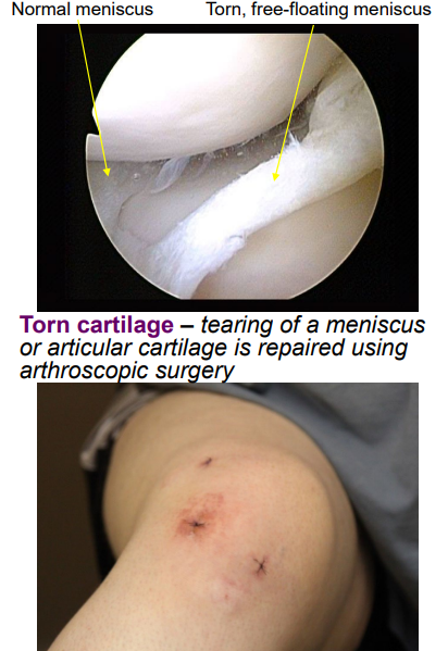 <ul><li><p>can be torn at a meniscus or articular cartilage</p></li><li><p>cartilage = avascular, cannot heal on its own</p></li><li><p>fixed using arthroscopic surgery</p></li></ul><p></p>