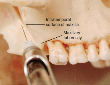 <p>-27-gauge short needle recommended</p><p>-area of insertion: height of the mucobuccal fold above the maxillary second molar</p><p>-target area: PSA nerve- posterior, superior, and medial to the posterior border of the maxilla</p><p>-landmarks: mucobuccal fold, maxillary tuberosity, zygomatic process of the maxilla</p><p>-orientation of the bevel: toward bone during the injection; if bone is accidentally touched, the sensation is less unpleasant</p>
