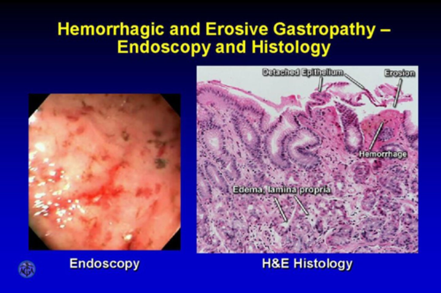 <p>Endoscopy to see if Linda has errosive or hemorrhagic gastropathy.</p><p>You can also order a CBC and hemoccult.</p>