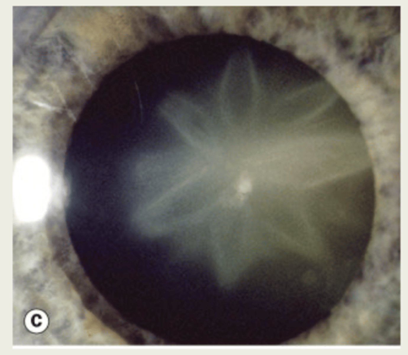 <p>sunflower cataract</p><p>rupture of lens capsule which results in an influx of aqueous into the lens</p>