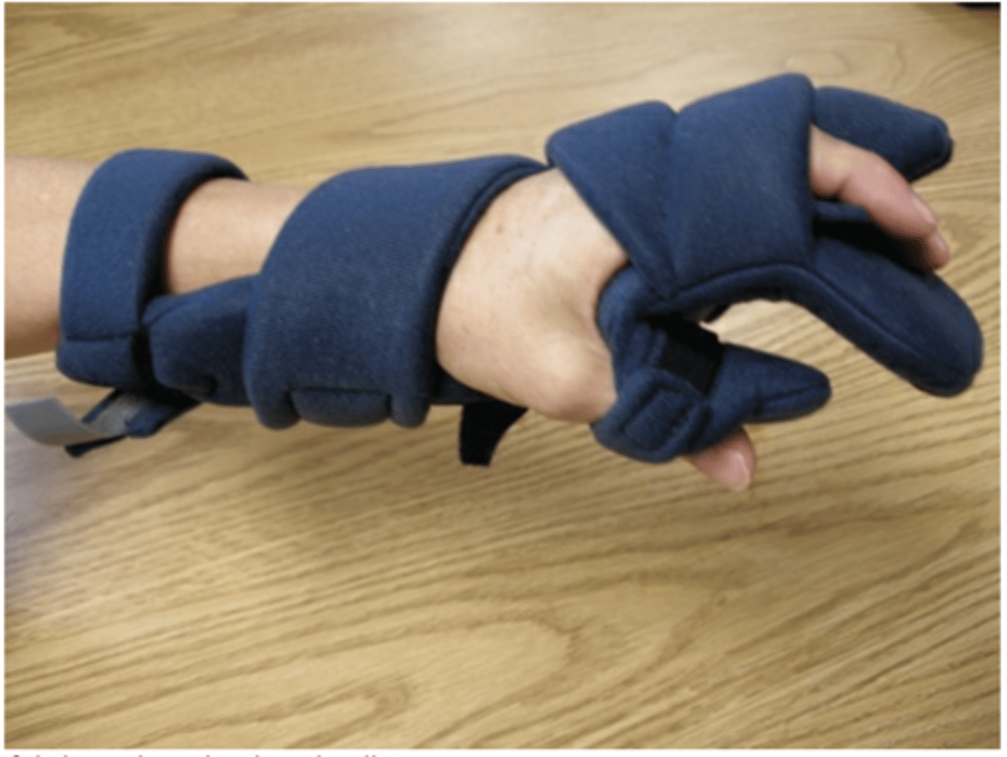 <p>Resting splints to decrease acute inflammation, decrease pain, protect joints</p>