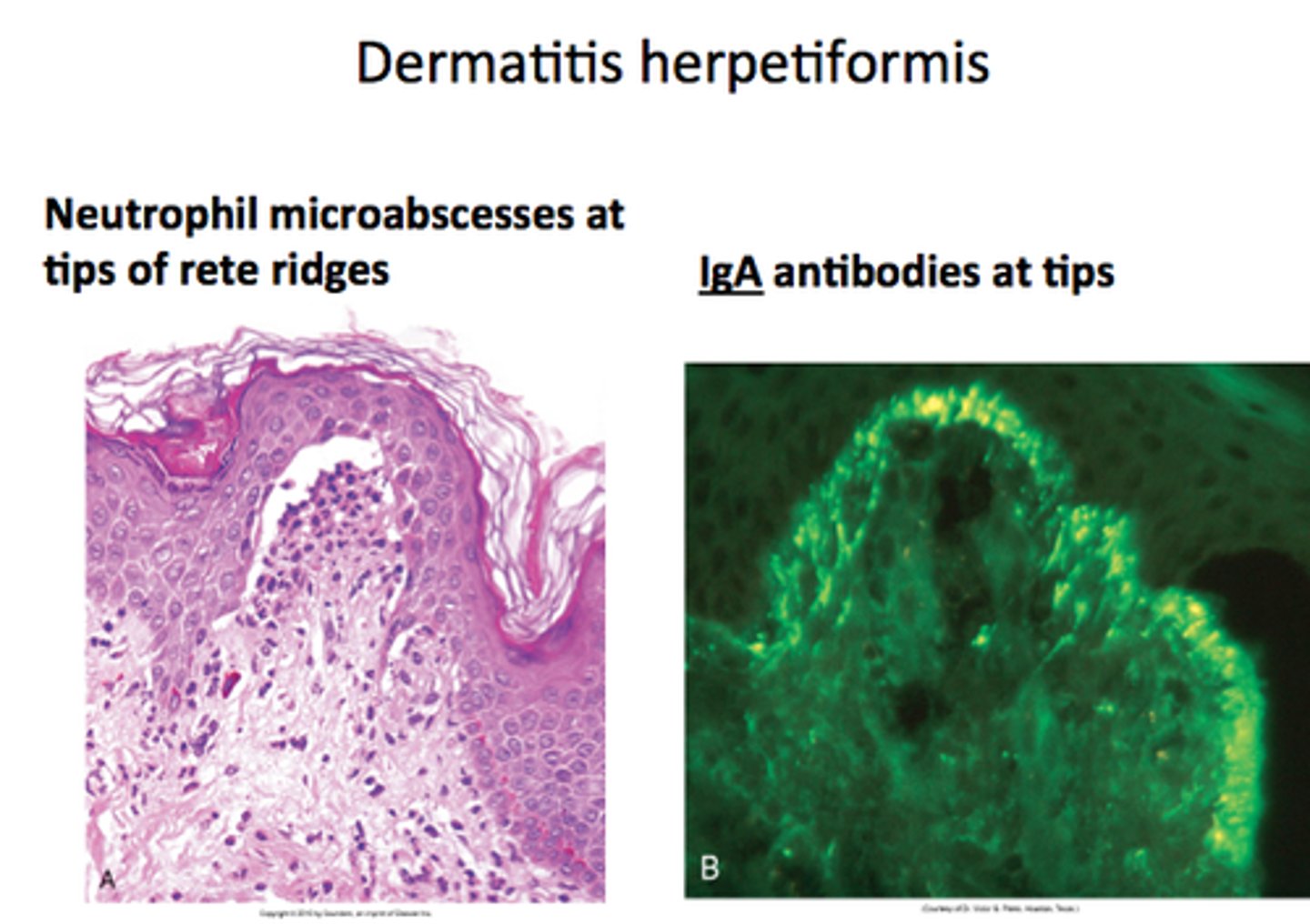 <p>DM 1</p><p>Dermatitis herpetiformis</p>