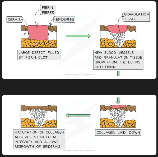 <p>scab is formed from blood clotting, stem cells divide by mitosis underneath. blood vessels form, collagen is produced, granulation tissue forms to fill the wound, stem cells move over the new tissue and produce epithelial cells, contractile cells cause wound contraction, unwanted cells die</p>