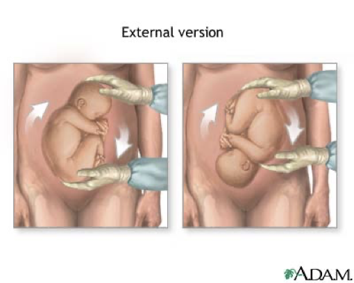 <p><span>a procedure where a healthcare professional manually turns a baby to make them go head first for labor</span></p>