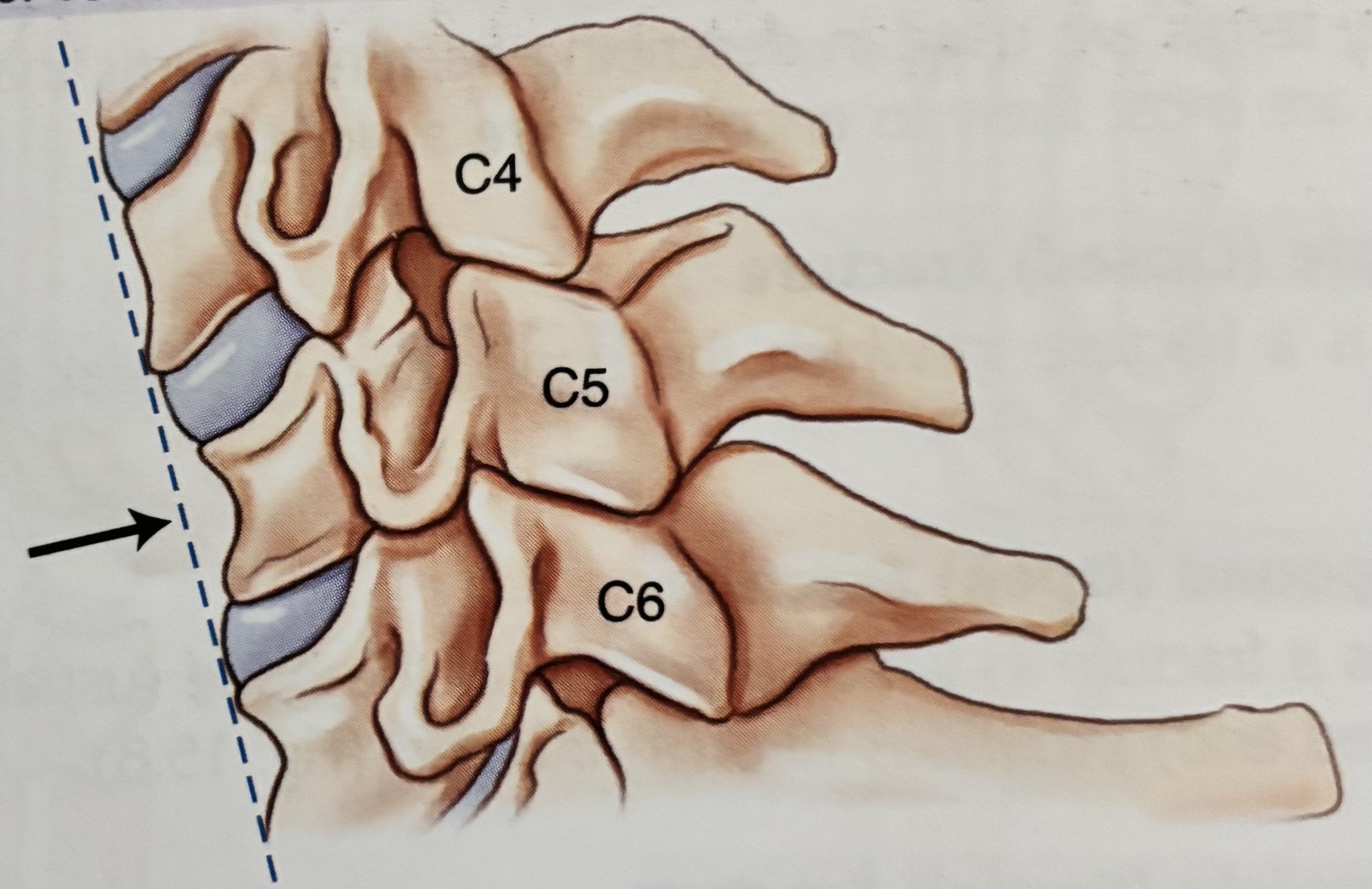 <p>What type of fracture is this?</p>