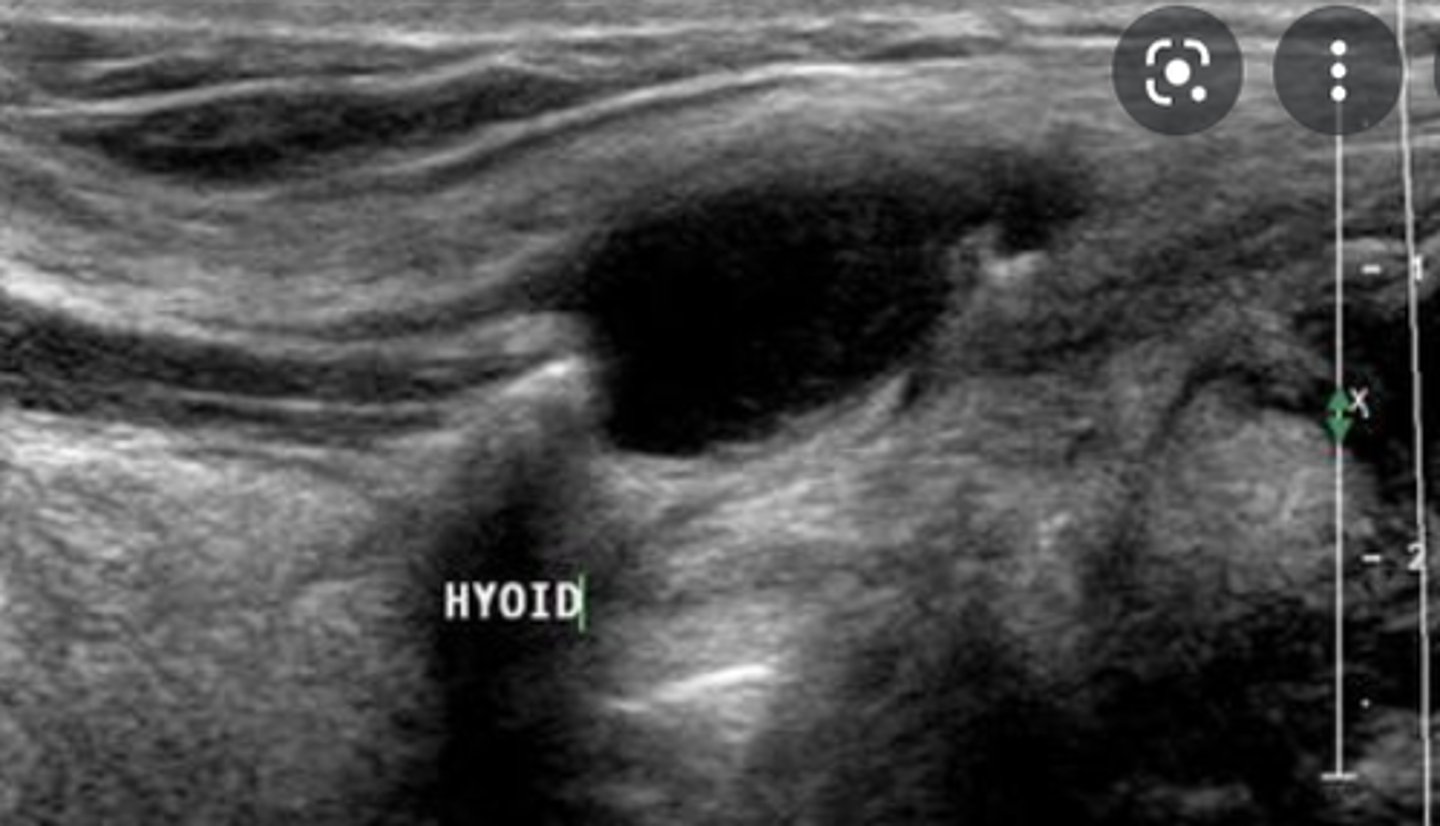 <p>Etiology</p><p>-Embryonic remnant</p><p>Clinical findings</p><p>-Asymptomatic</p><p>-Palpable superficial anterior neck mass</p><p>Sonographic findings</p><p>-Anechoic superficial neck mass</p><p>-Located between the tongue and the thyroid isthmus</p><p>-May demonstrate internal debris</p><p>-Document relationship to hyoid bone (e.g., inferior)</p>