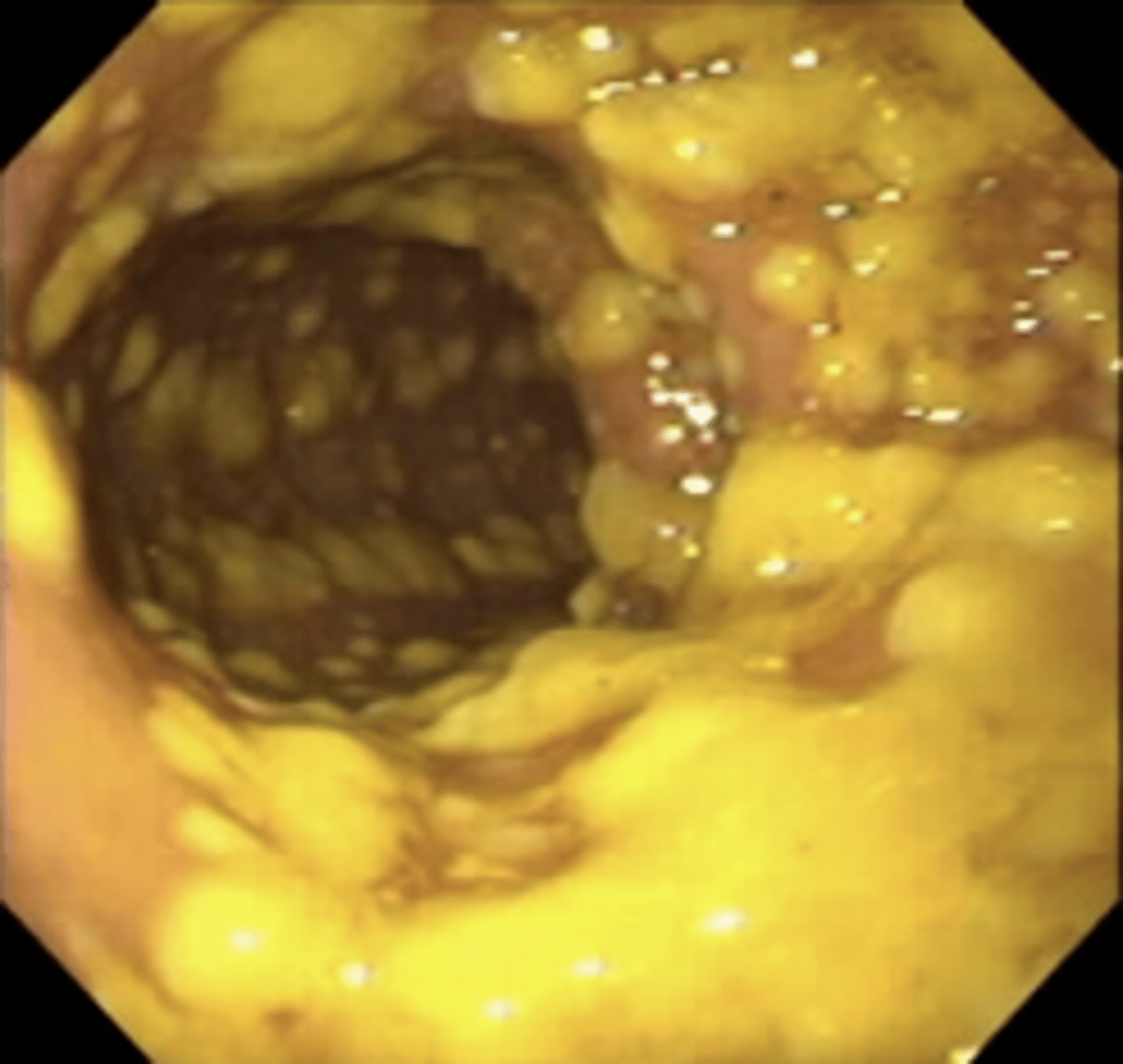 <p>FQs<br>Ampicillin<br>Clindamycin<br>Third (3rd) Gen Cephalosporins</p>
