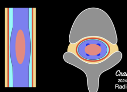 <p>Tumor originating w/n <strong><u>neural tissue</u></strong></p>