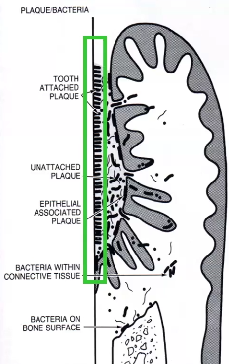 <ol><li><p>Formation of the Pellicle:</p><ul><li><p>All surfaces are normally covered with glycoprotein pellicle in the tooth surface as well as tissue surfaces and fixed/removable surfaces (but since epithelial tissue sloughs off, plaque doesn’t form there)</p></li><li><p>pellicle structure determines which bacteria can attach</p></li></ul></li><li><p>Initial adhesion/attachment of bacteria</p><ul><li><p>Gram + bacteria are usually the primary colonizers and coat the most coronal tooth surface</p></li><li><p>Adhesins on bacteria attach to pellicle</p></li></ul></li><li><p>Colonization and plaque maturation</p><ul><li><p>Co-aggregation: primary colonizers let secondary colonizers adhere to them</p></li><li><p>Gram - bacteria are usually the secondary colonizers and coat soft tissues as well as the most apical tooth surfaces</p></li></ul></li></ol><p></p>