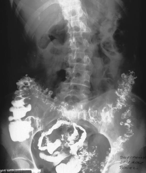 <p>The sigmoid colon.</p>