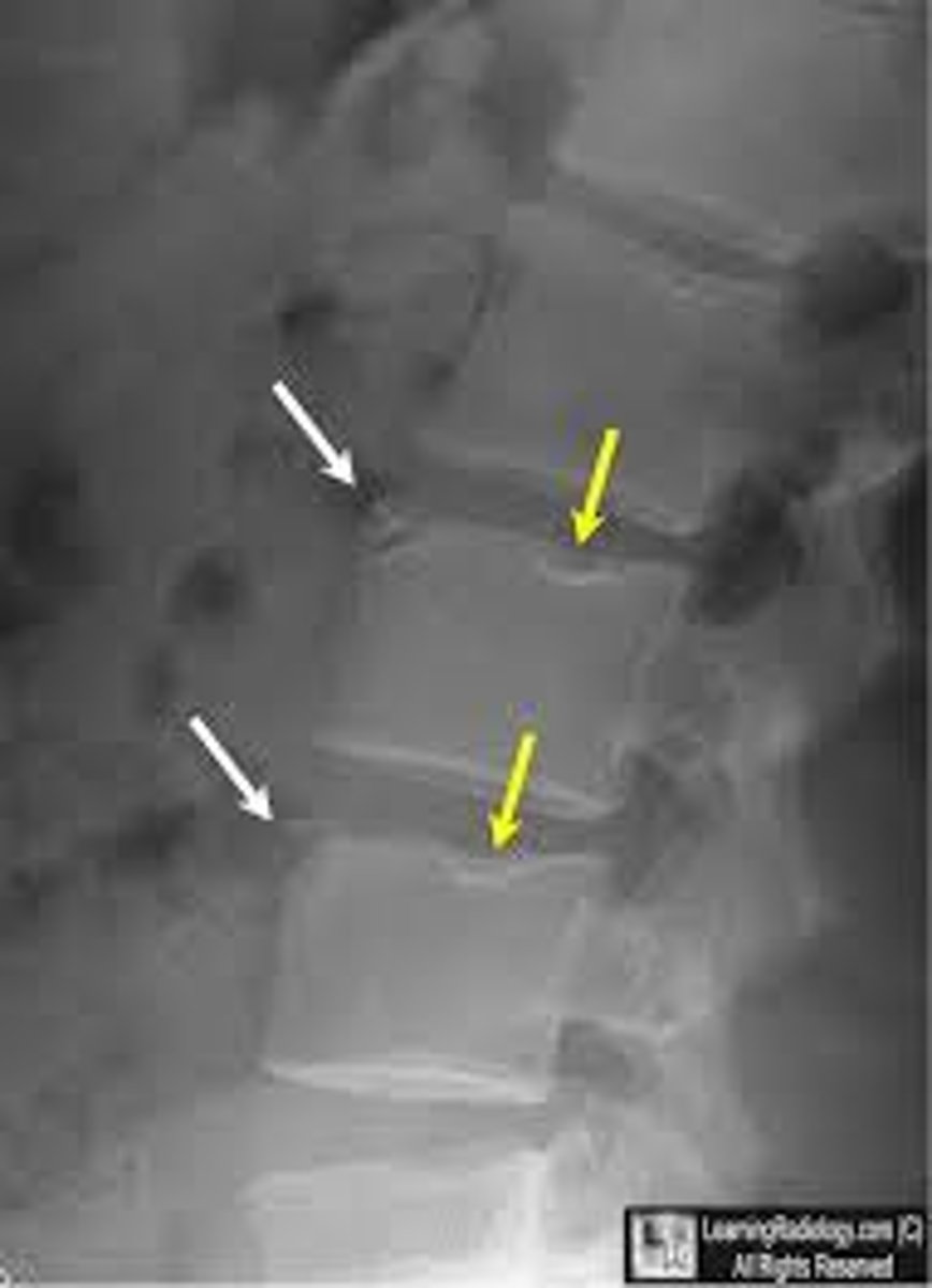 <p>herniation of the nucleus pulposus through the vertebral endplate into the vertebral body</p><p>*occurs Scheuermann's disease</p>