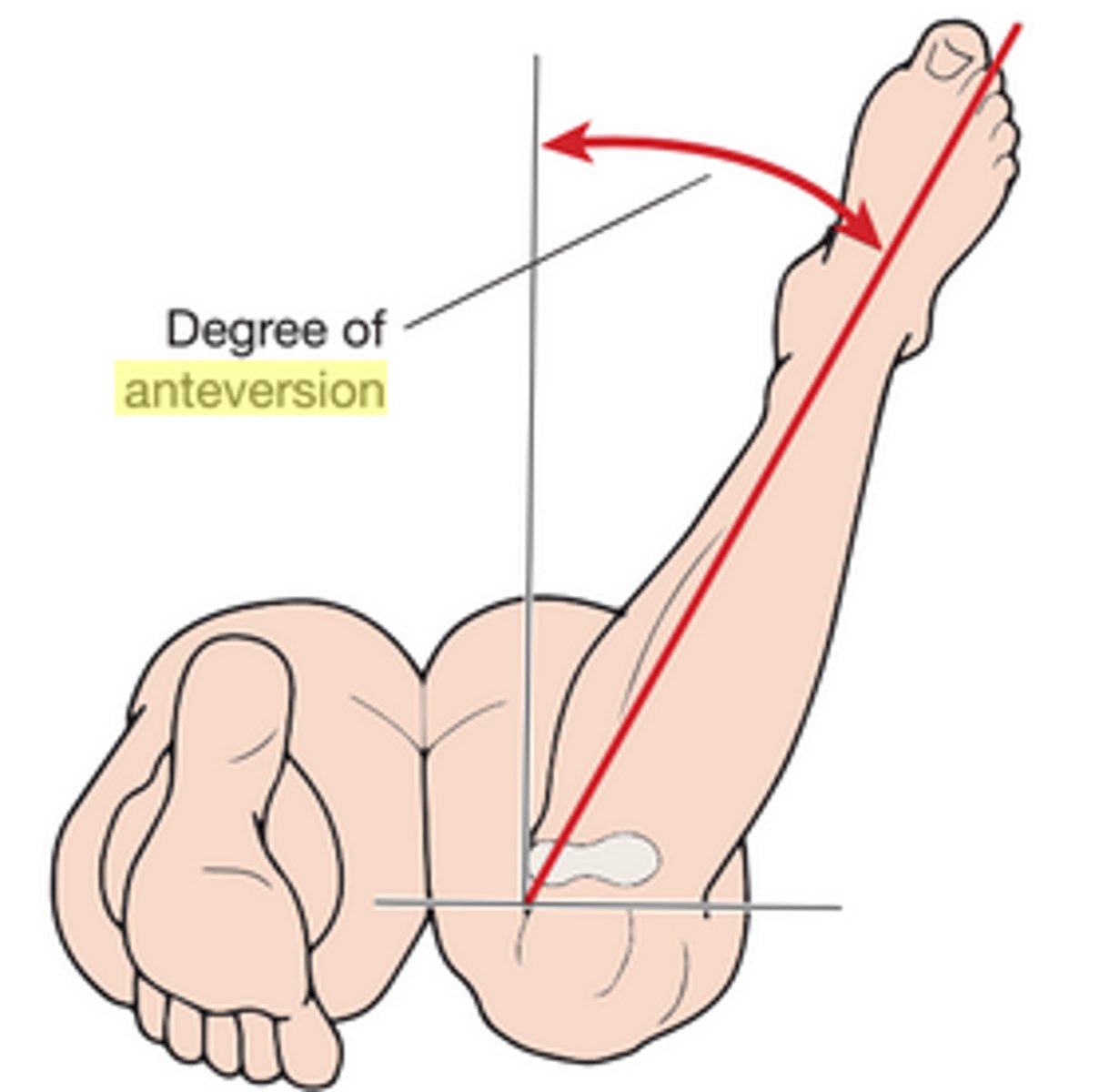 <p>for femoral anteversion:</p><p><8 deg is retroversion, >15 degrees is anteversion</p>