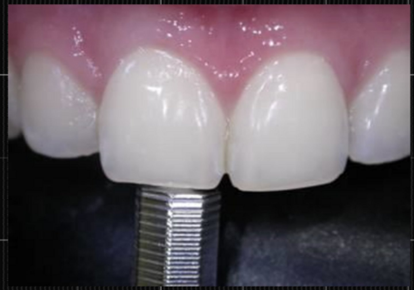 <p>- Anamnesis (spontaneuous pain?)</p><p>- Clinical inspection</p><p>- Palpation</p><p>- Percussion</p>