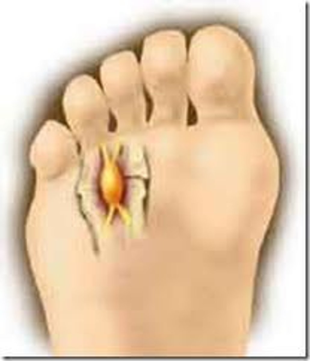 <p>age: 40-60</p><p>MOI: gradual</p><p>weight bearing increases symptoms on sole of foot</p><p>pronated foot or flattened arch can be observed</p><p>passive toe extension painful</p><p>tenderness with palpation of web space or toes</p>