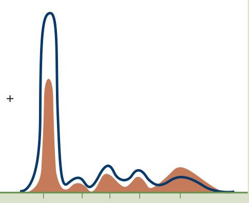 <p>Decrease in all zones except gamma (increased) due to a failure of the liver to synthesize proteins (Decreased albumin, alpha 1 and 2, beta, Increased gamma)</p>