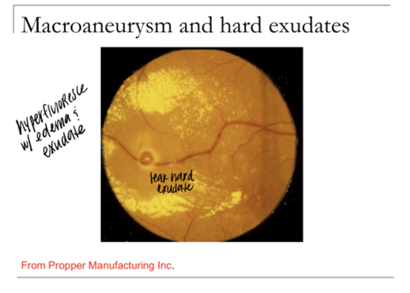 <p>When do retinal macroaneurysms occur?</p>