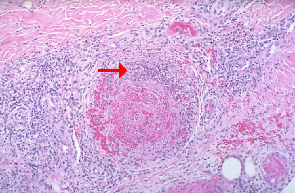 <ol><li><p>Identify pathology</p></li><li><p>What is demonstrated?</p></li></ol>
