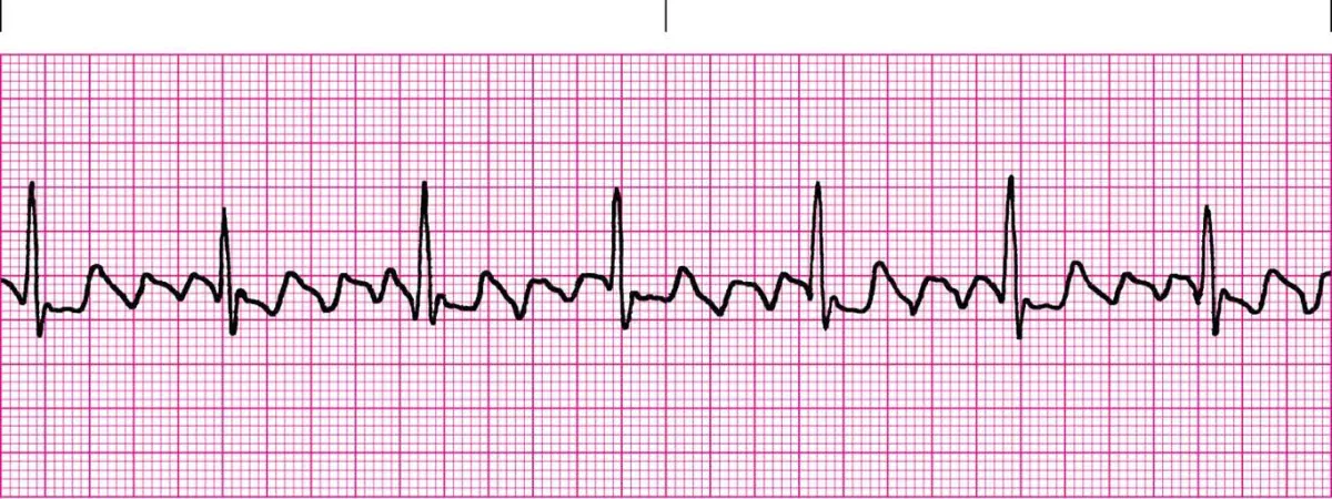<p>a saw tooth patterned arrhythmia</p>