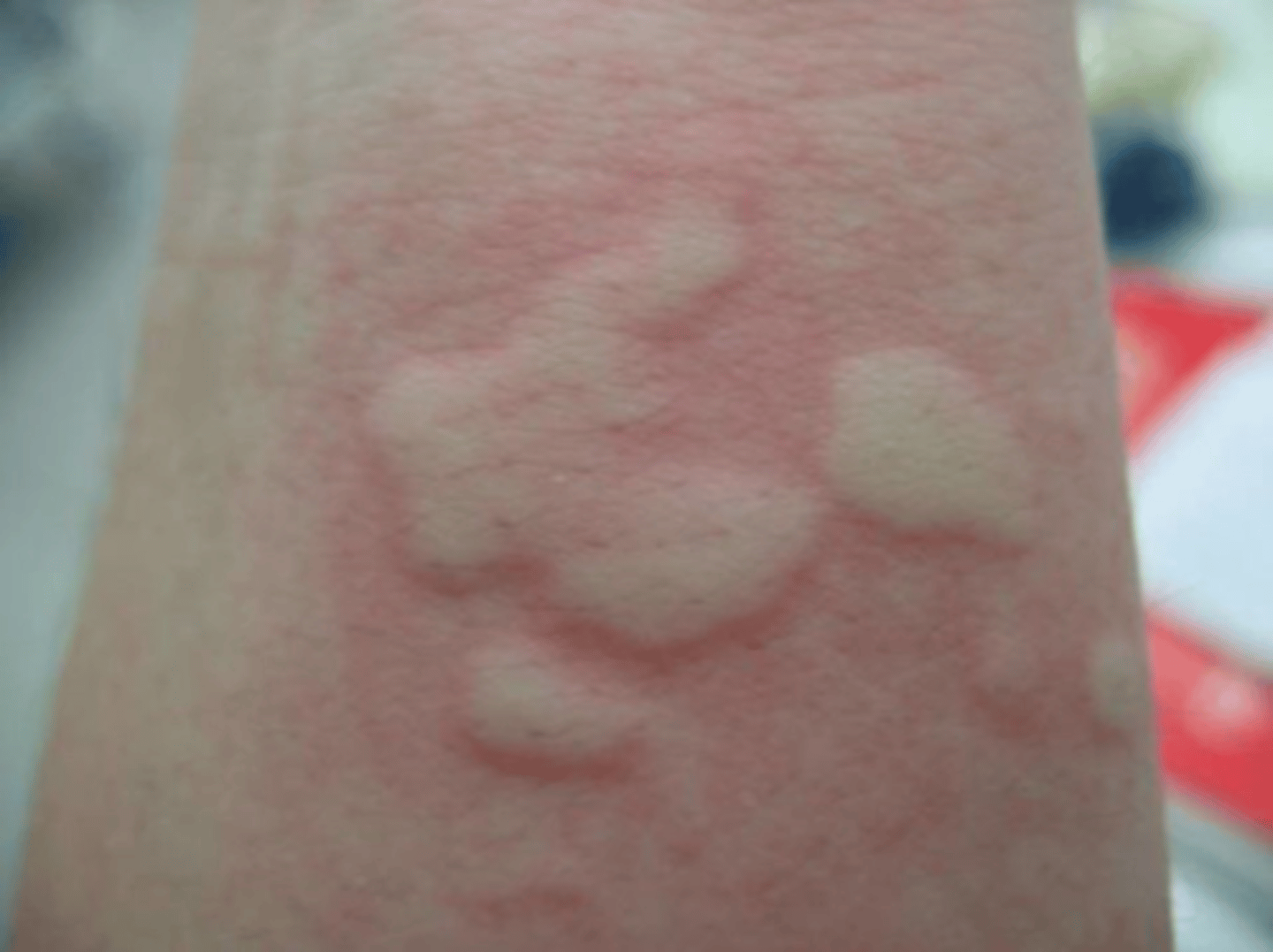 <p>wheal-and-flare reaction confined to one region of the body</p>