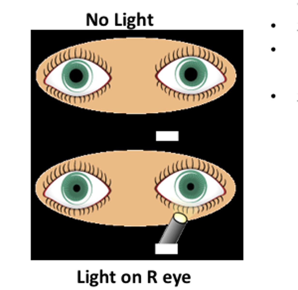 <p>Reflex caused by light stimulation of cranial nerve II (optic) causing iris constriction by cranial nerve III (oculomotor).</p>