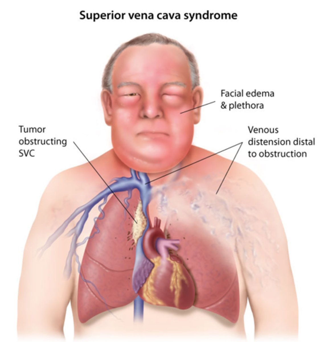 <p>progressive occlusion of the superior vena cava that leads to venous distention of upper extremities and head</p>